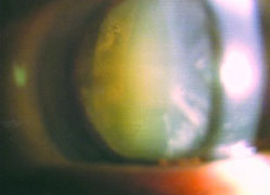 白内障イメージ1