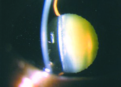 白内障イメージ2